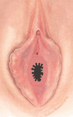 Hymen denticularis