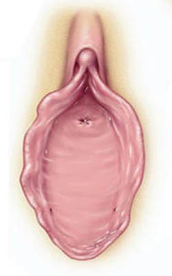 Hymen imperforatus