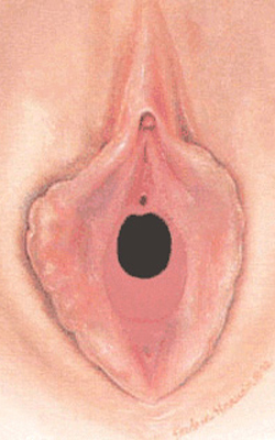 Hymen semilunaris