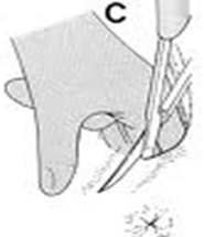 Epizyotomi insizyonu