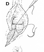 Epizyotomi dikilmesi