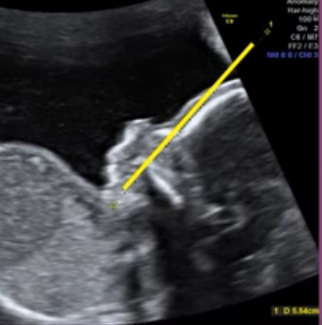 Fetal Profil Hattı Ultrason Görünümü