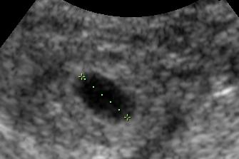 Transvajinal ultrasonda dış gebelik