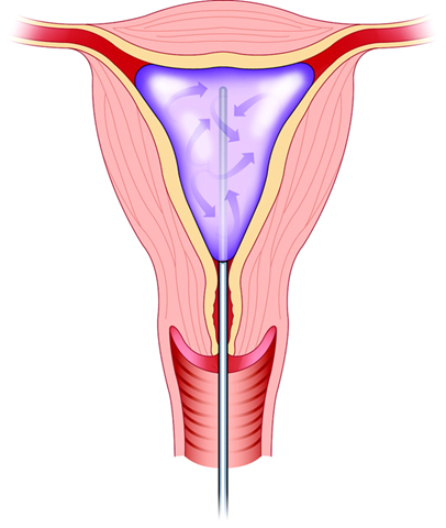 Endometrial Ablazyon