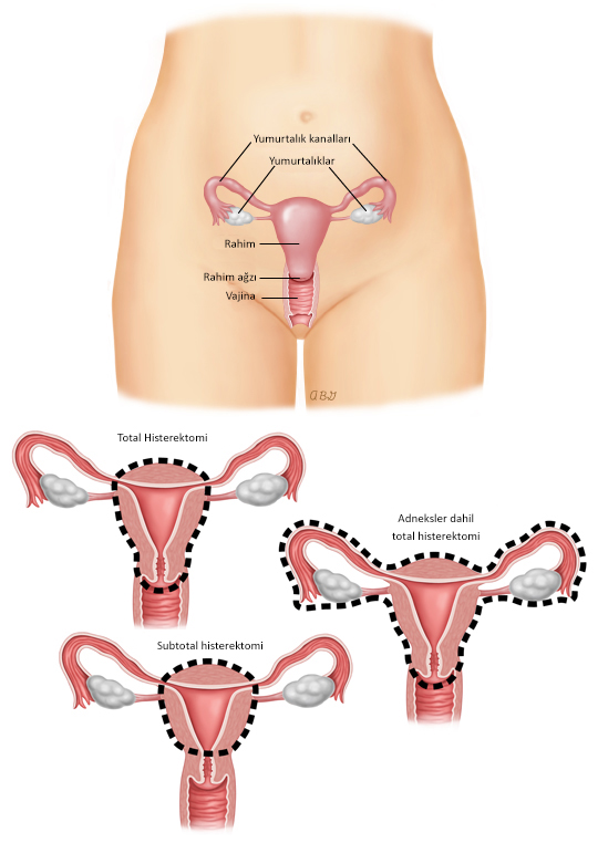Abdominal Histerektomi Türleri