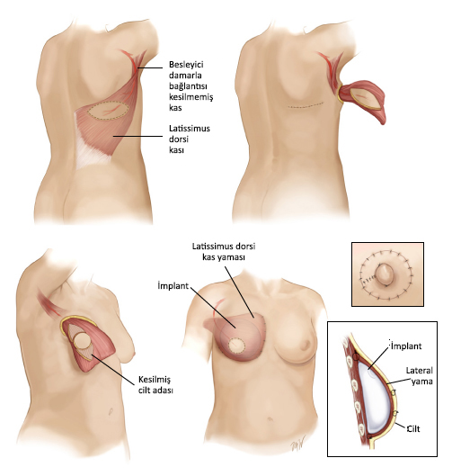 Lat flap ile rekonstrüksiyon