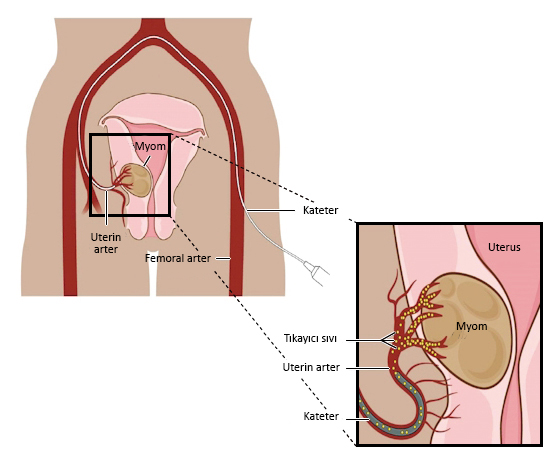 Uterin Arter Embolizasyonu