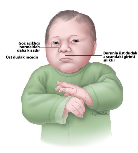 Fetal Alkol Sendromlu Bebek